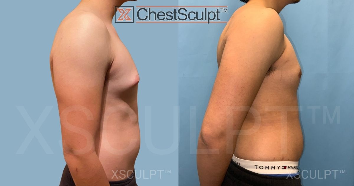 1821006 Teen gynecomastia before after by Dr. Marc Adajar Xsculpt Chicago Illinois1