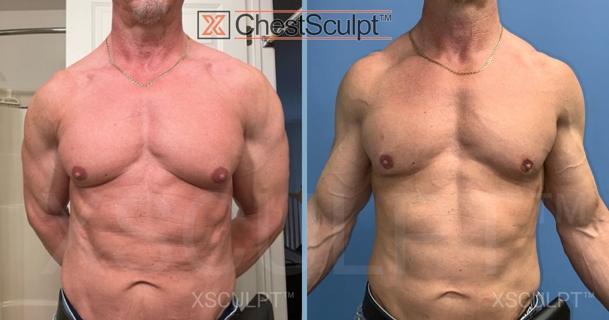 Dr. Marc Adajar Reviews Gyencomastia Surgery Xsculpt Chicago Illinois (2)