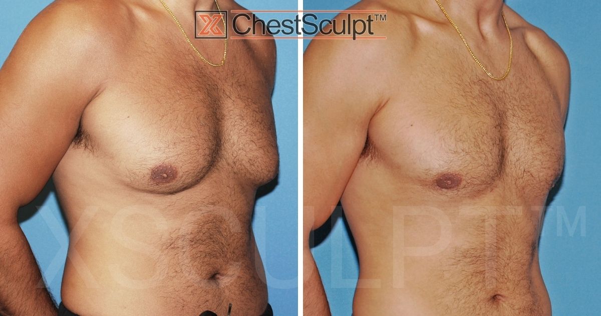 Gynecomastia Surgery Before and After Photo ChestSculpt Chicago Illinois