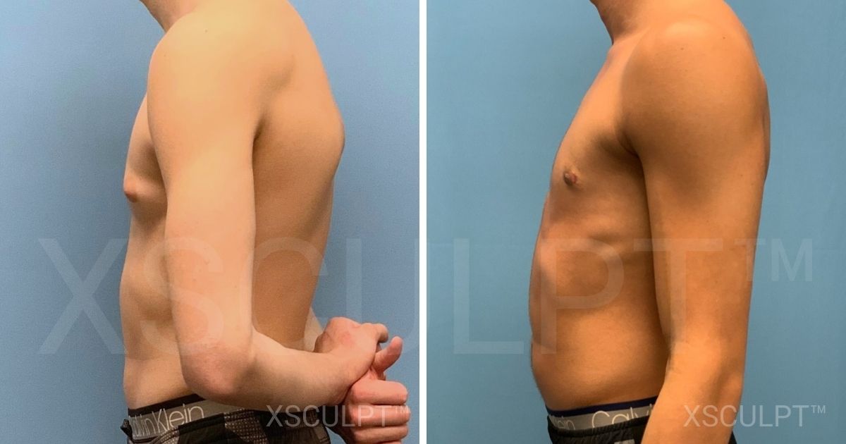 Teen gynecomastia before after by Dr. Marc Adajar Xsculpt Chicago Illinois 1710486