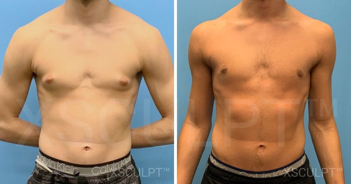 Teen gynecomastia before after by Dr. Marc Adajar Xsculpt Chicago Illinois 1710486