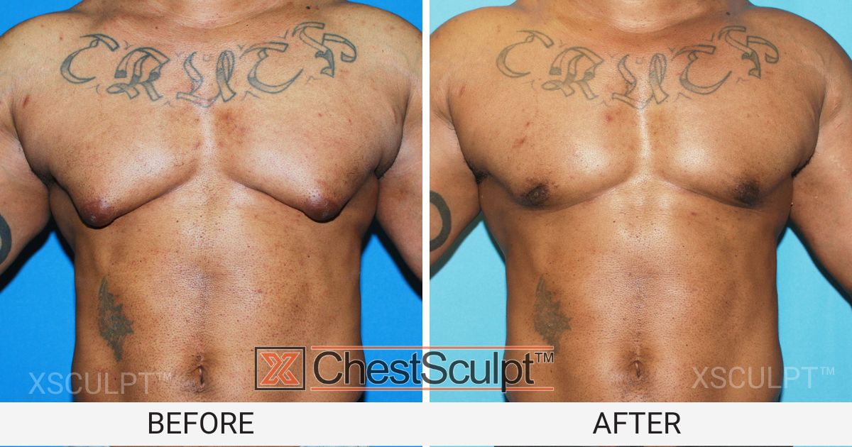 Bodybuilder gyno surgery before and after by GynecomastiaMD Chicago Illinois