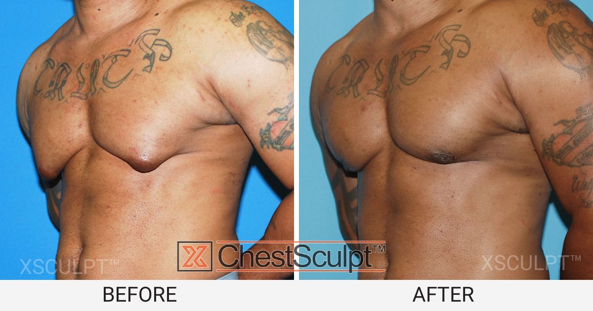 Bodybuilder gyno surgery before and after by GynecomastiaMD Chicago Illinois