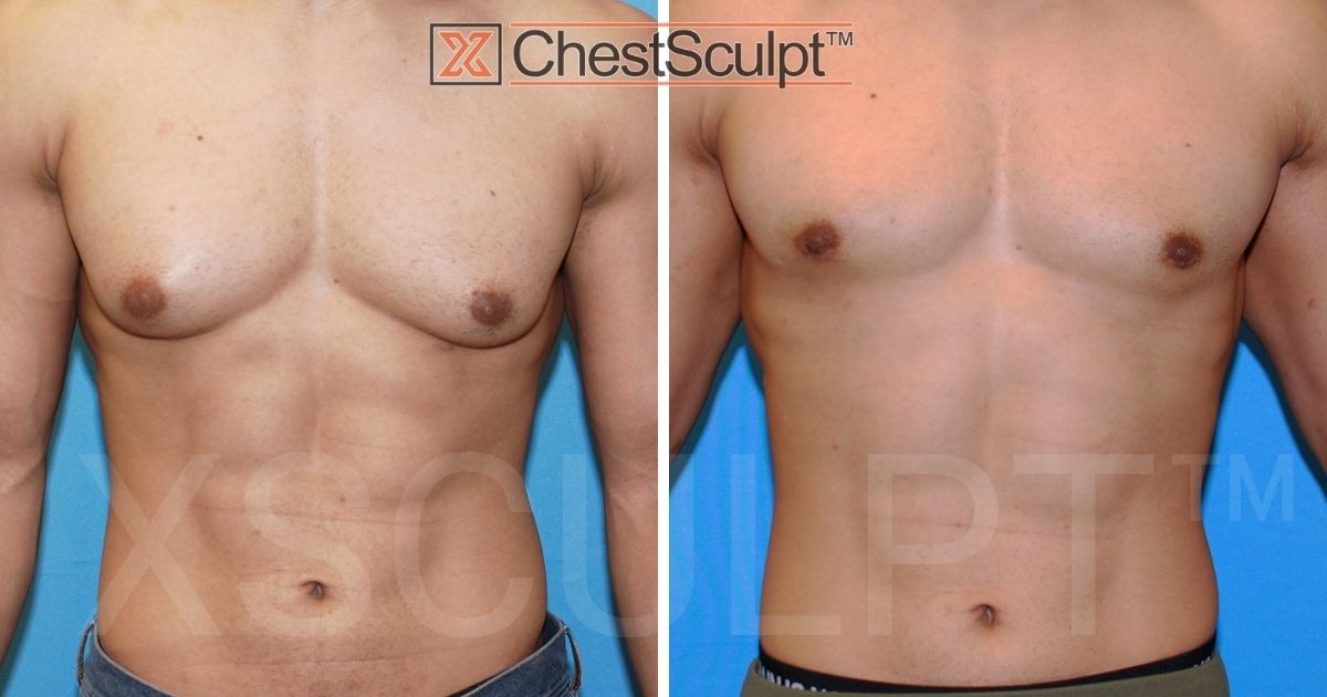 bodybuilder-gynecomastia-before-after-xsculpt-chicago-illinois