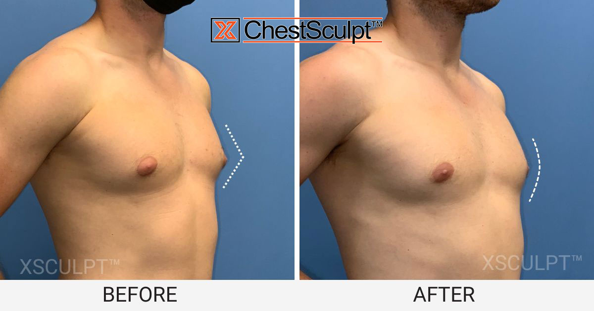 male pointy puffy nipples before after photo gynecomastia chicago illinois