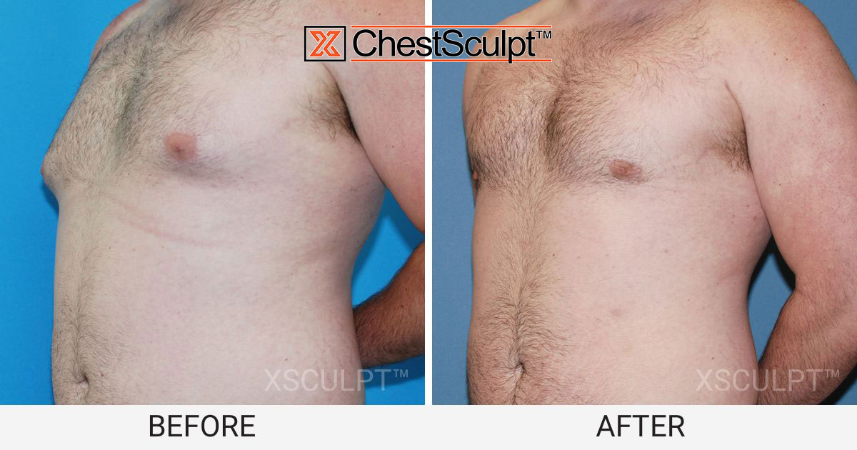 male pointy puffy nipples before after photo gynecomastia chicago illinois