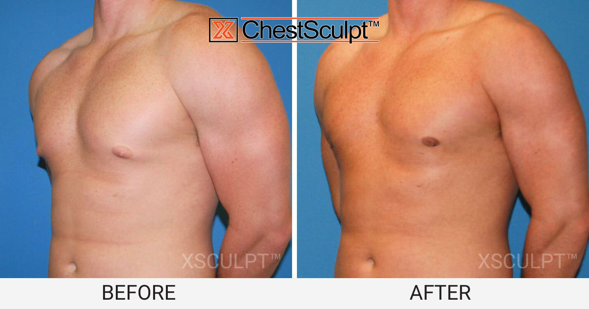 male pointy puffy nipples before after photo gynecomastia chicago illinois