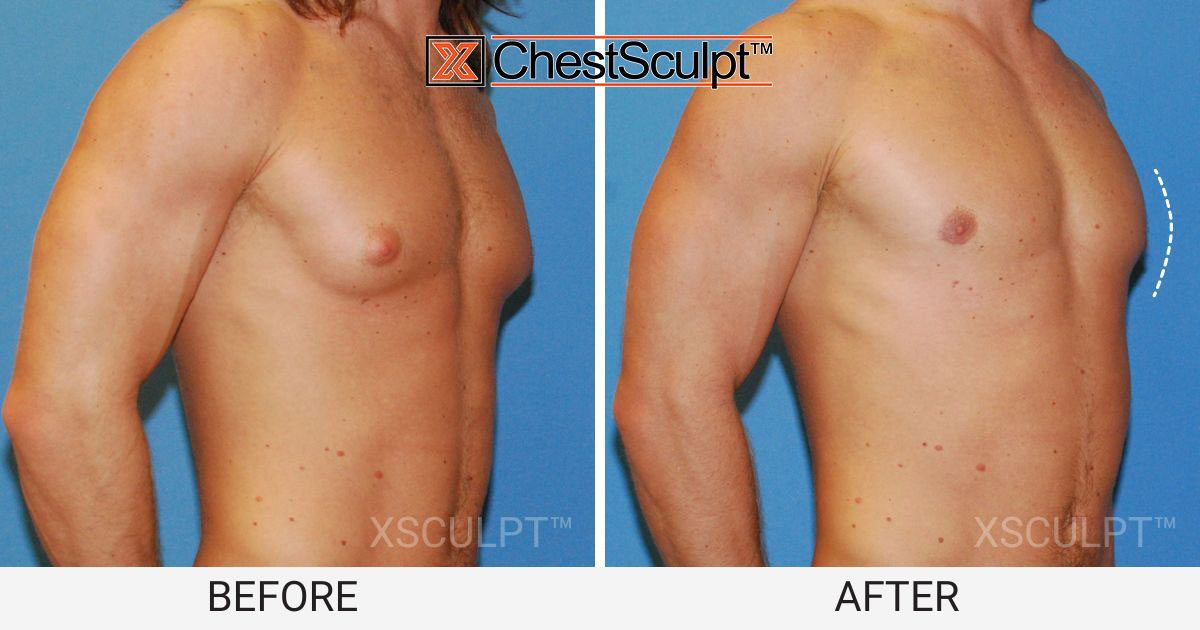 male pointy puffy nipples before after photo gynecomastia chicago illinois