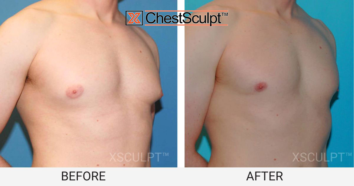 male pointy puffy nipples before after photo gynecomastia chicago illinois