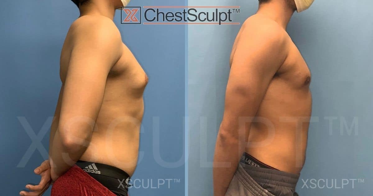 Teen gynecomastia before after by Dr. Marc Adajar Xsculpt Chicago Illinois
