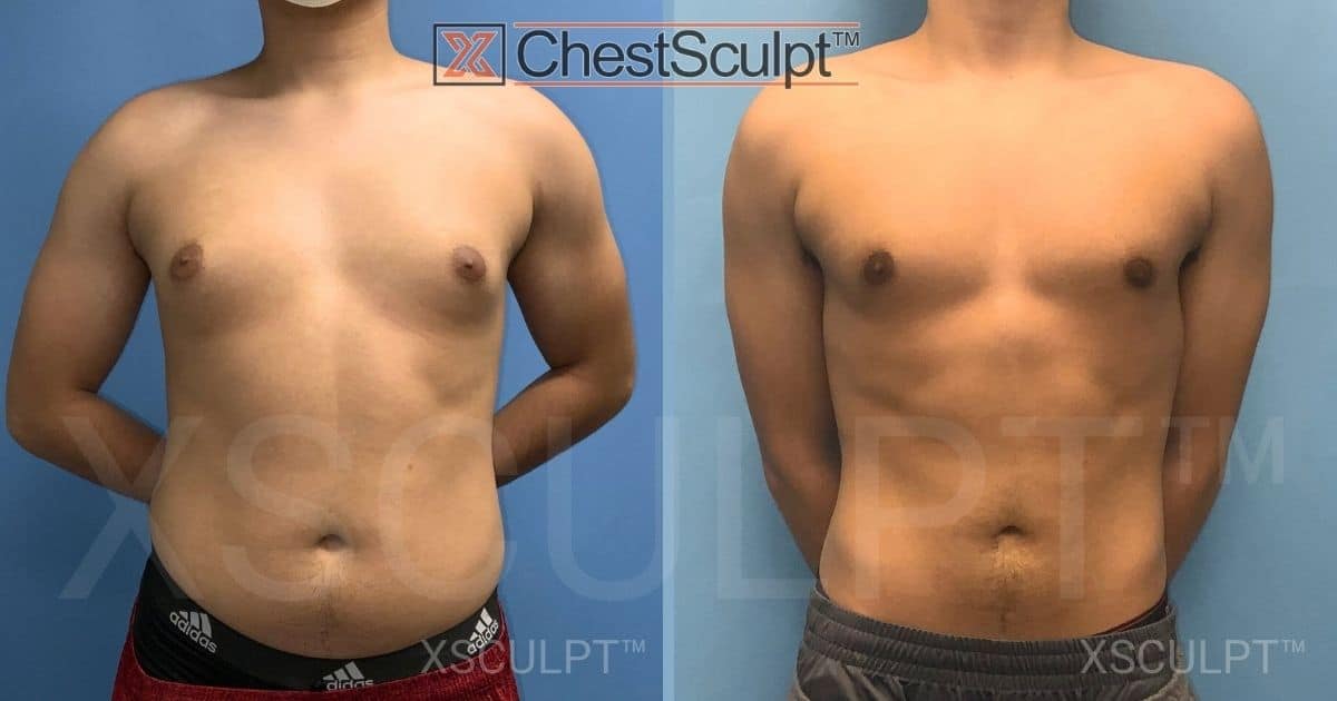 Teen gynecomastia before after by Dr. Marc Adajar Xsculpt Chicago Illinois