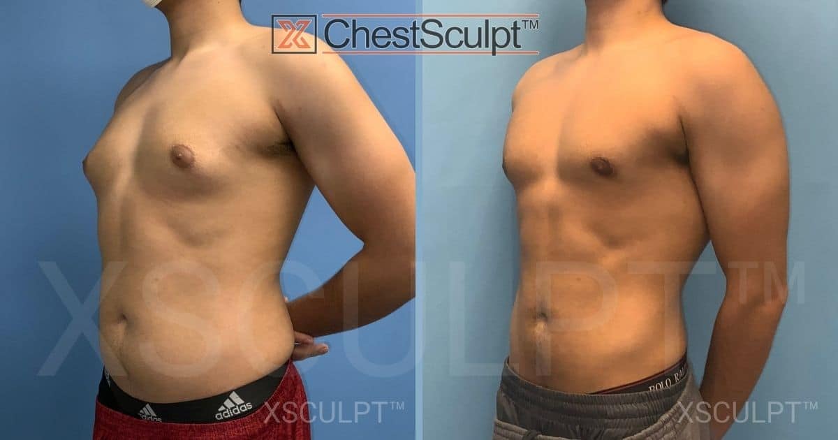 Teen gynecomastia before after by Dr. Marc Adajar Xsculpt Chicago Illinois