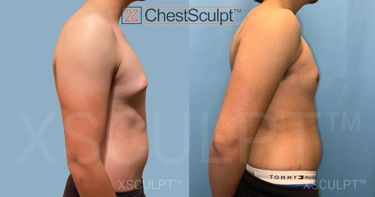 Teen gynecomastia before after by Dr. Marc Adajar Xsculpt Chicago Illinois