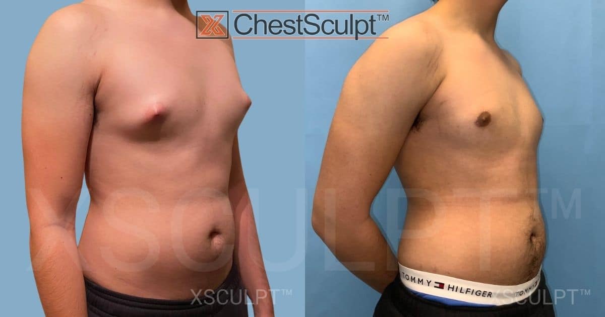 Teen gynecomastia before after by Dr. Marc Adajar Xsculpt Chicago Illinois