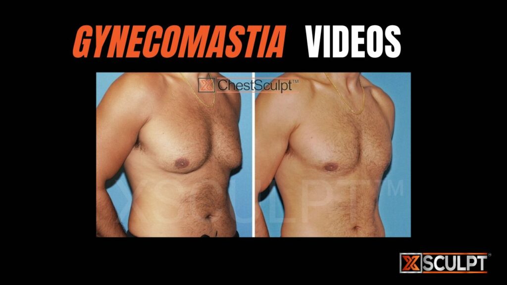 Gynecomastia Surgery Videos XSculpt