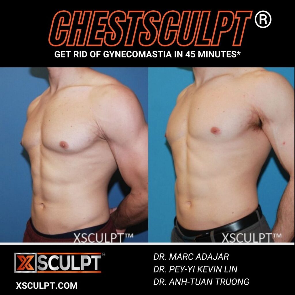 Grade 2 Gynecomastia Man Boobs before after photo by Xsculpt