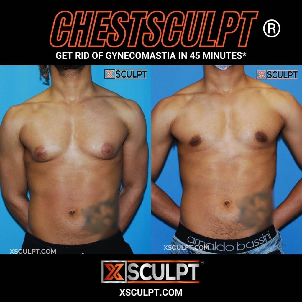 Grade 2 Gynecomastia Man Boobs before after photo by Xsculpt