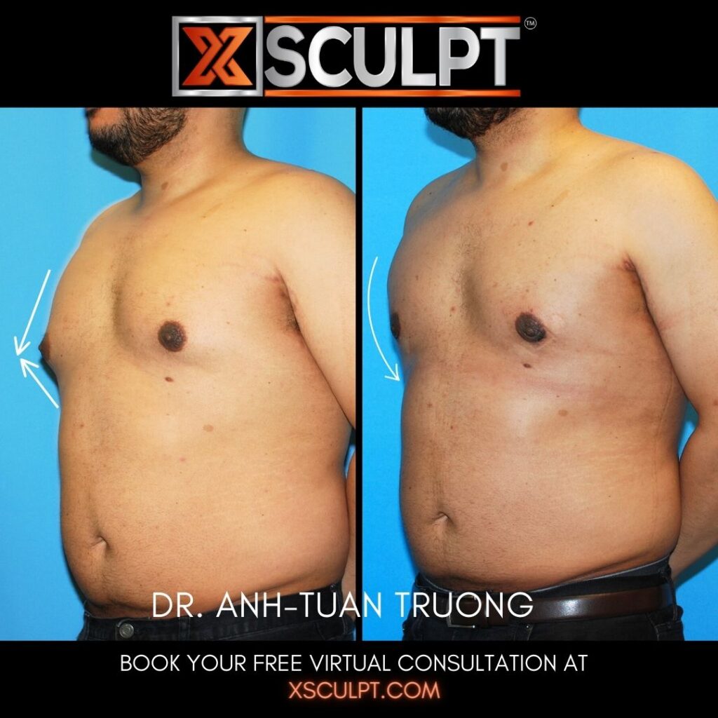 Grade 1 Gynecomastia Man Boobs before after photo by Xsculpt