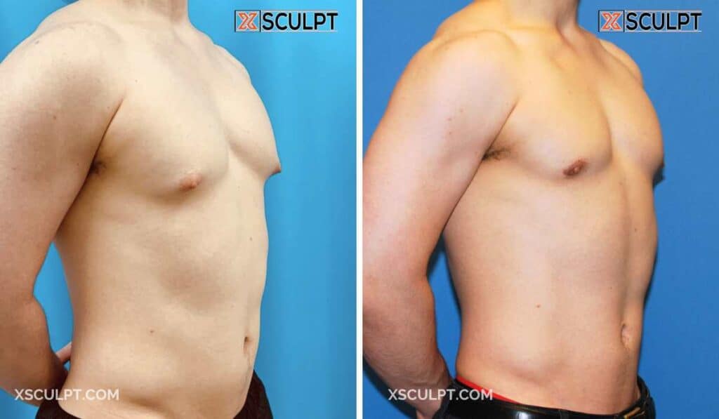 Grade 1 Gynecomastia by Dr. Marc Adajar