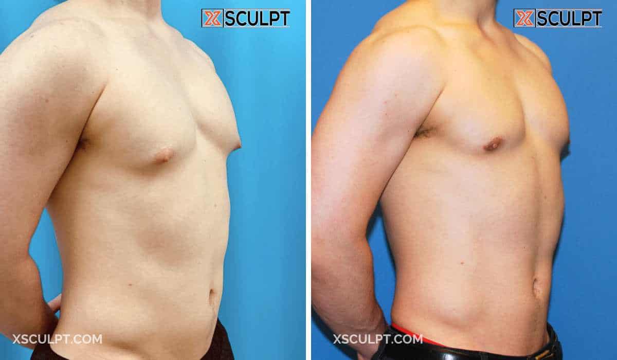 Gynecomastia Puffy Nipple Grade 1 by Dr Marc Adajar